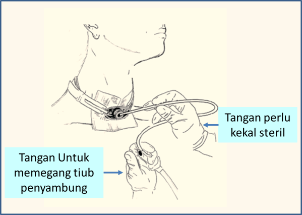 Menyedut trakeostomi